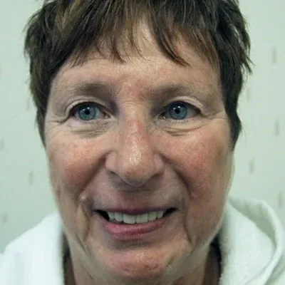An actual patient after dental procedures with Dr. Bjorklund.